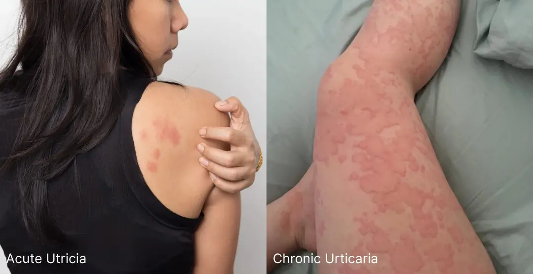 Types of Hives